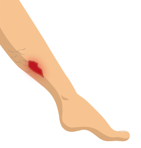 leg ulcer