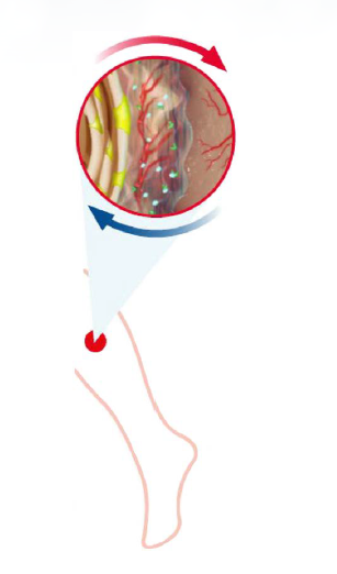 venous leg ulcer